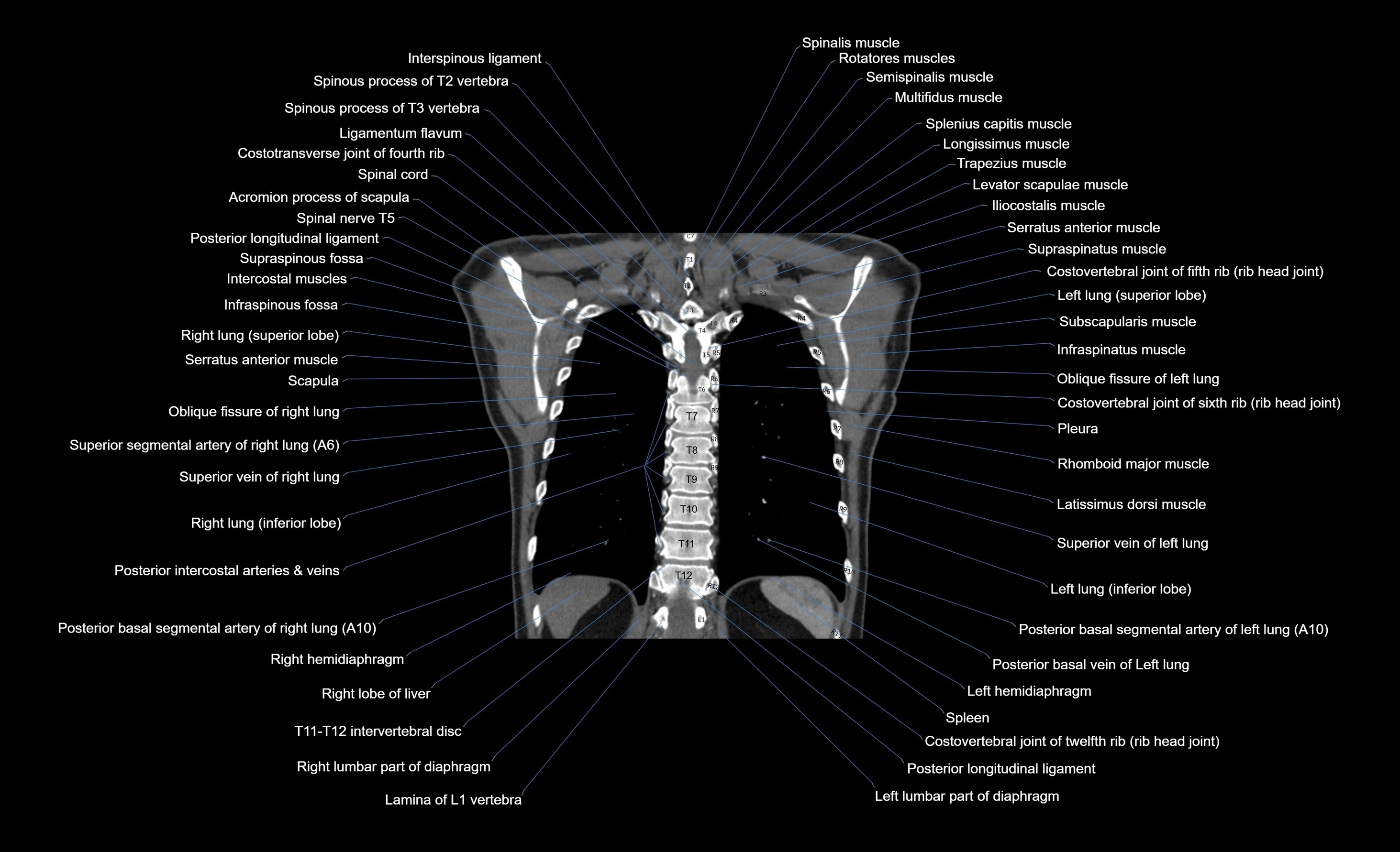 CT chest (thorax) labelled coronal cross sectional anatomy radiology image-00029.webp